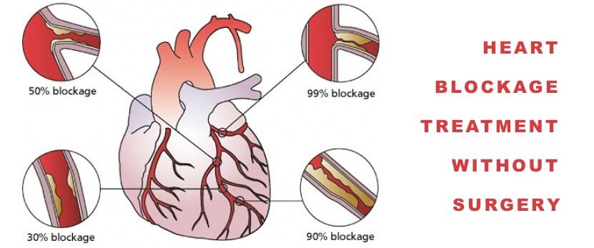 heart-blockage-shanikrupaheartcare