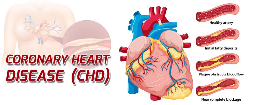 coronary heart disease (CHD)