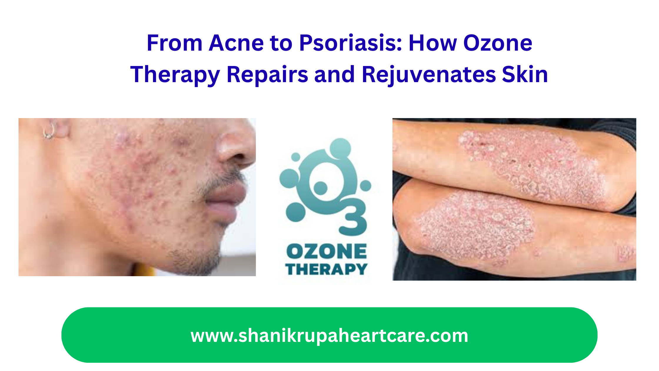 From Acne to Psoriasis: How Ozone Therapy Repairs and Rejuvenates Skin